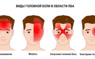 Боль в области лба