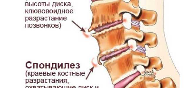 Спондилез