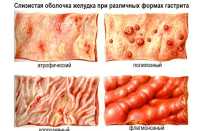 Пангастрит