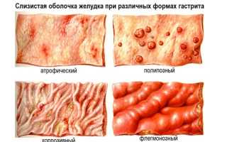 Пангастрит