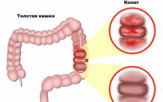 Эрозивный колит