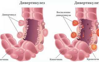 Дивертикул