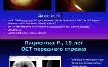Кератоувеит