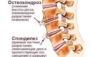 Спондилез грудного отдела позвоночника